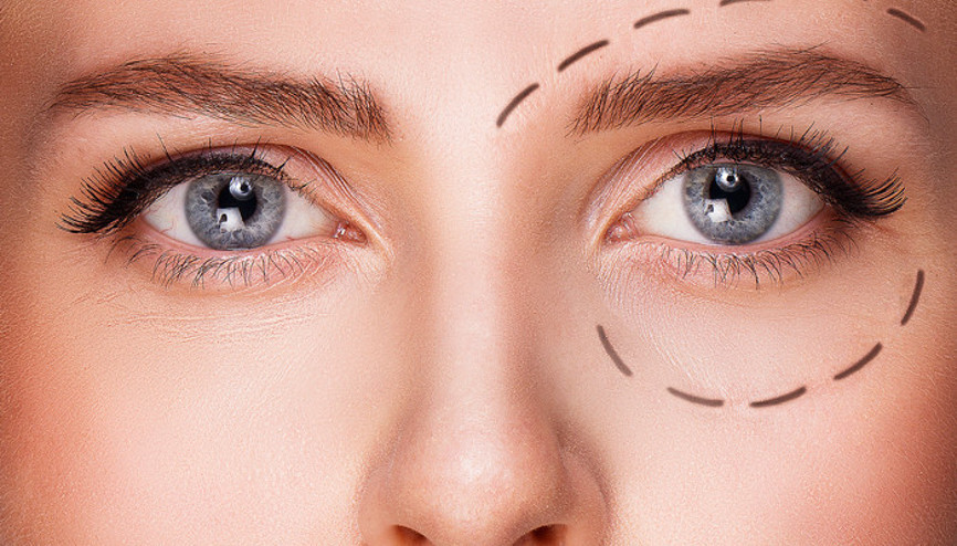 Göz çevresi estetikleri Göz çevresi estetikleri