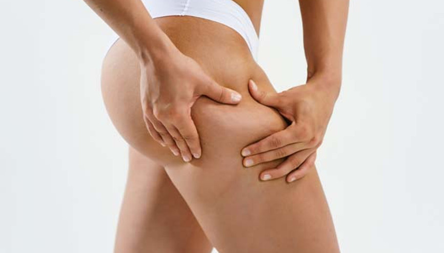 Adım Adım Selülitten Kurtulma Rehberi