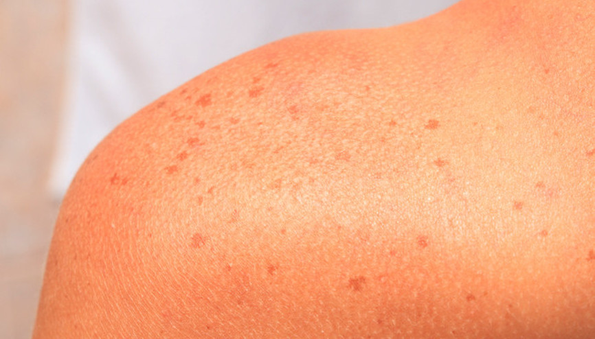 30 yaşından sonra çıkan benlere dikkat