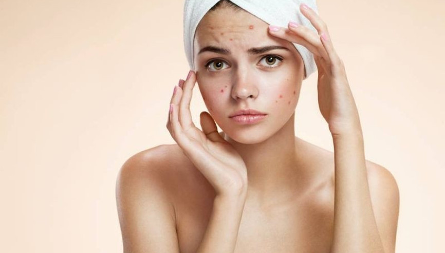 Ergenlik sivilcesi neden olur