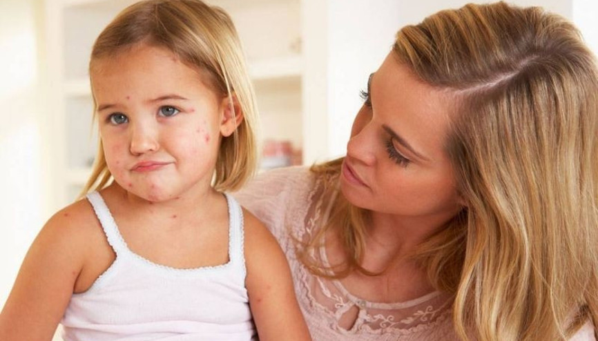 Suçiçeğinin belirtileri ve tedavisi