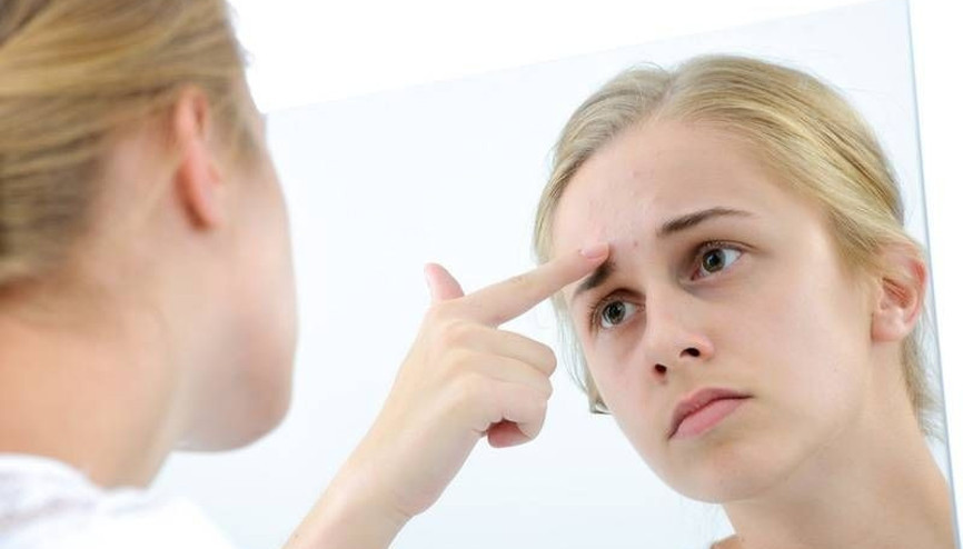 Ergenlik döneminin kabusu: Akne