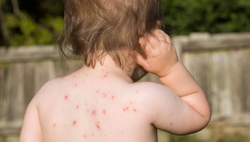 Suçiçeği nasıl bulaşır ve tedavi edilir