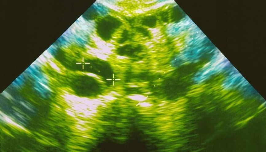 Bu hastalık gebe kalmayı zorlaştırıyor