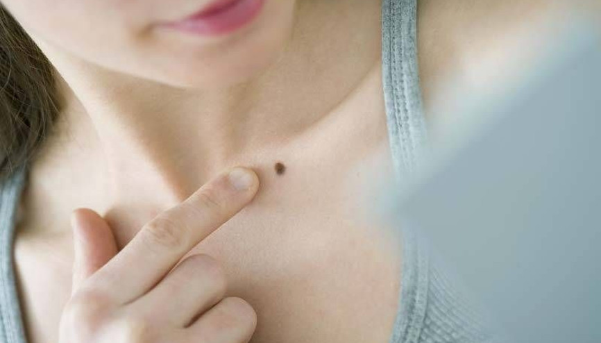 Lazer ile benlerin yakılması doğru değil