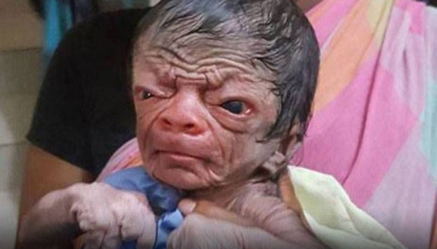 Benjamin Button gibi yaşlı doğdu