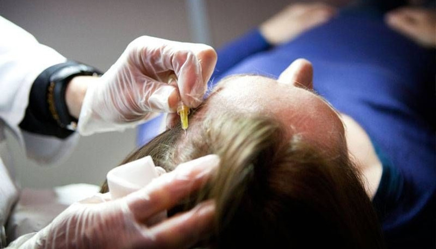 Saç mezoterapisiyle saçınızı güzelleştirin