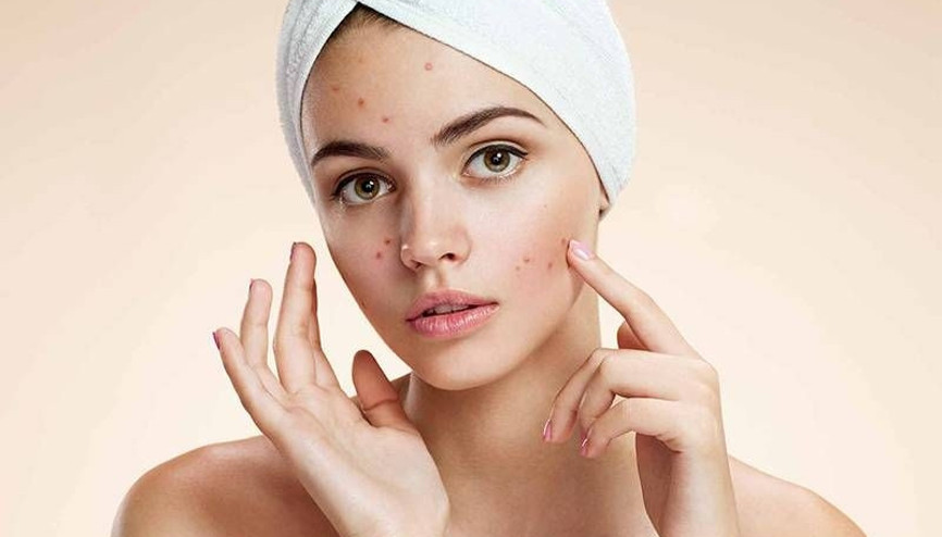 Sivilce gençlerin öz güvenini zedeliyor Sivilce gençlerin öz güvenini zedeliyor