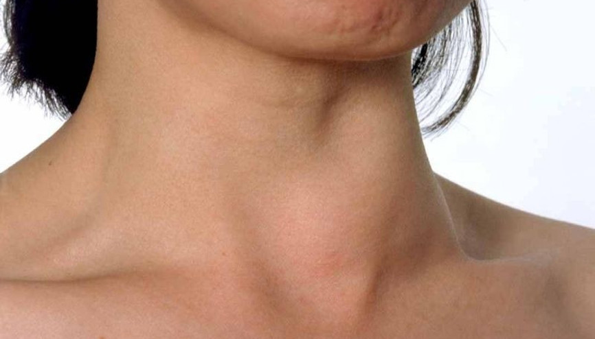 Guatr hastalığı nedir Guatr belirtileri nelerdir