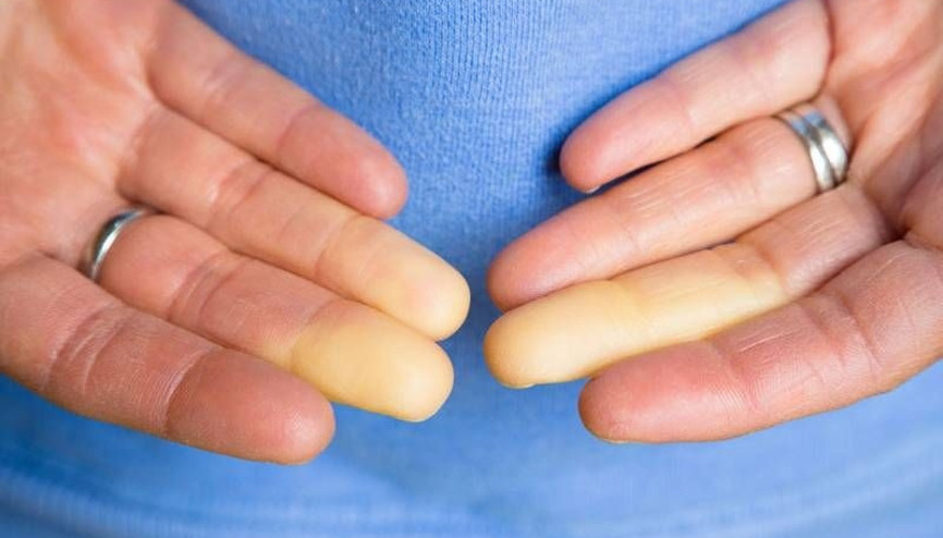 Raynaud hastalığı nedir Kimlerde görülür