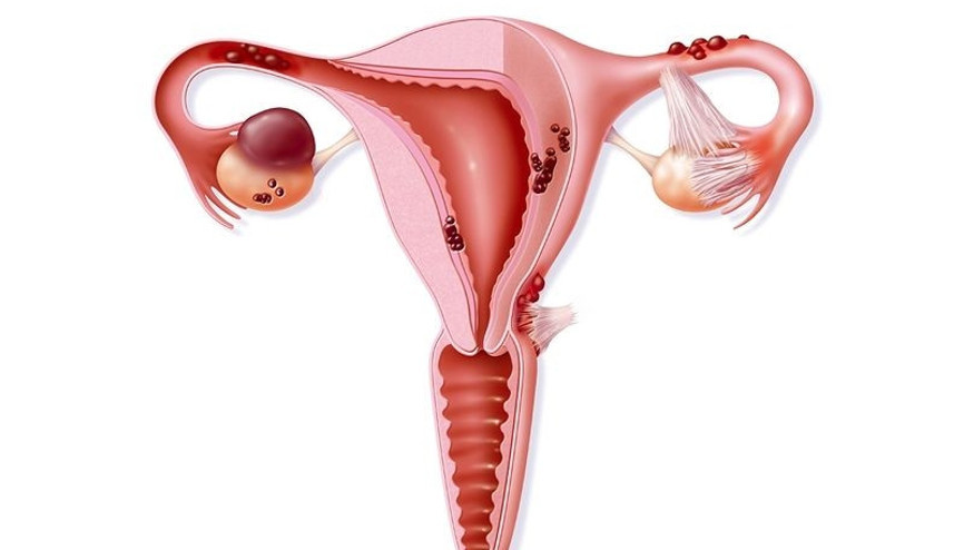 Miyom nedir Miyom tedavisi nasıl yapılır Miyom nedir Miyom tedavisi nasıl yapılır