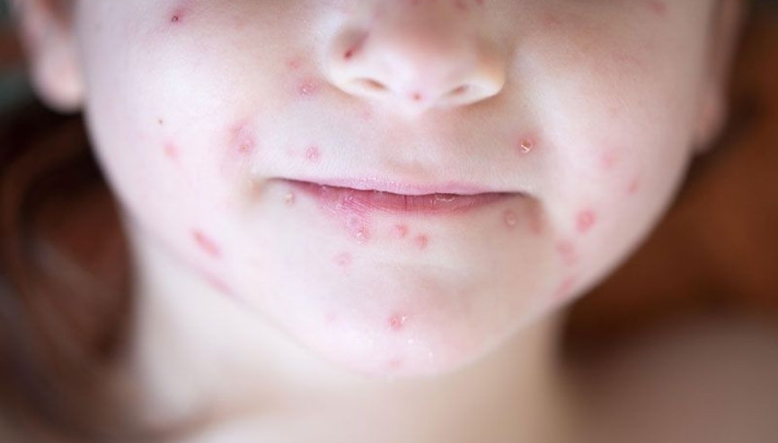 Çocuklarda kızamık nedenleri, belirtileri ve tedavisi