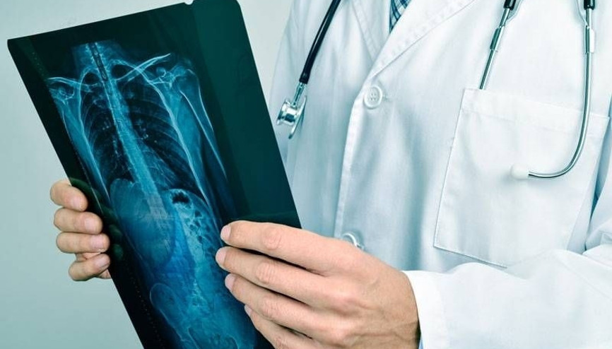 Küçük hücreli akciğer kanserine karşı müdahale