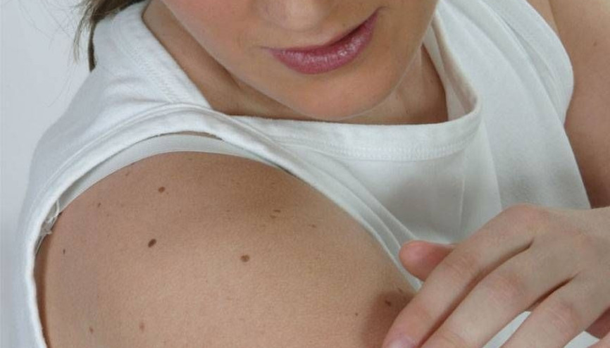 Aniden büyüyorsa dikkat Güneş lekelerinden korunun