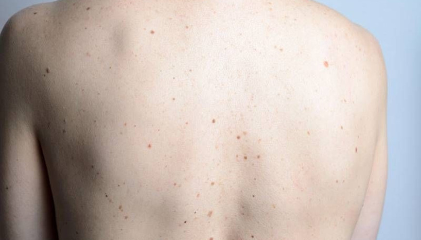 Yeni çıkan benler neyin işaretçisi