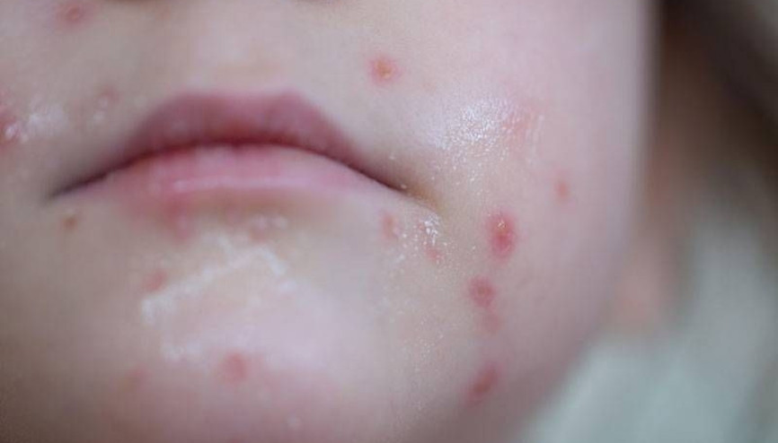 Aşı reddi toplum için tehdit oluşturuyor