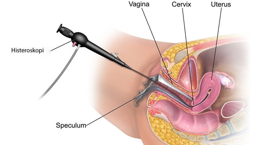 Histeroskopi nedir Histeroskopi hangi alanlarda kullanılır Histeroskopi nedir Histeroskopi hangi alanlarda kullanılır