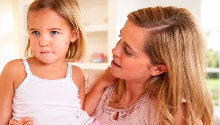 Kızamık nedir Kızamık belirtileri ve tedavisi