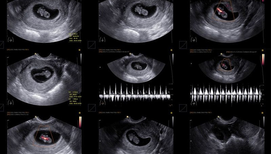 Gebelik kesesi hamileliğin kaçıncı haftasında görülür