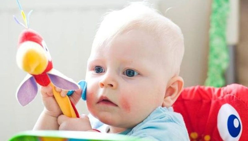 Bebeklerde atopik dermatite karşı etkili öneriler