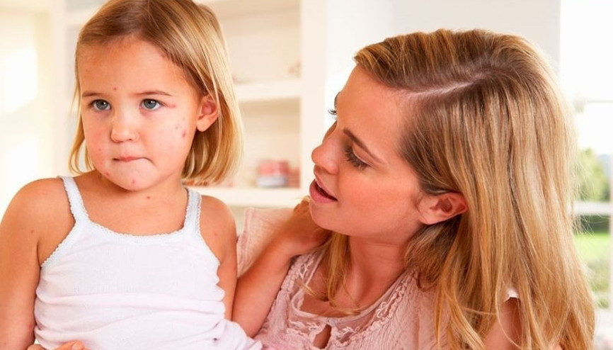 Kızamık belirtileri nelerdir Kızamık tedavisi nasıl yapılır