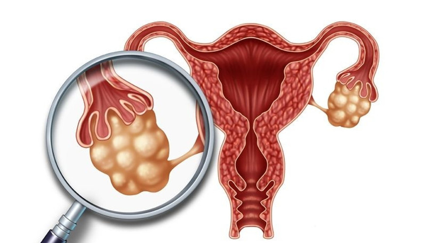 Polikistik Over Sendromu nedir PKOS hastaları hamile kalabilir mi