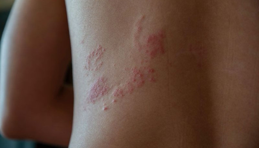 Zona nedir Zona hastalığı belirtileri ve tedavisi Zona nedir Zona hastalığı belirtileri ve tedavisi