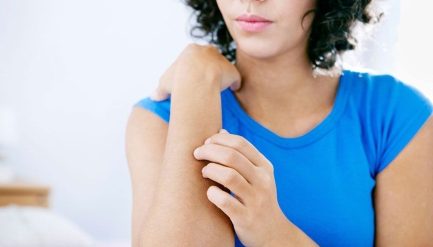 Ürtiker hastalığında bitkisel tedaviden kaçınmalısınız