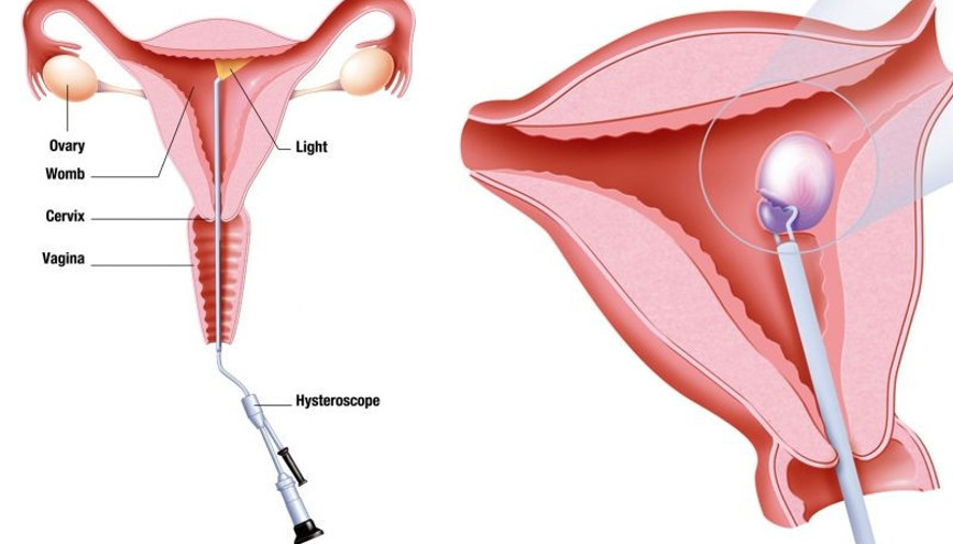 Anne olma şansını artıran yöntemlerden biri: Histeroskopi Anne olma şansını artıran yöntemlerden biri: Histeroskopi