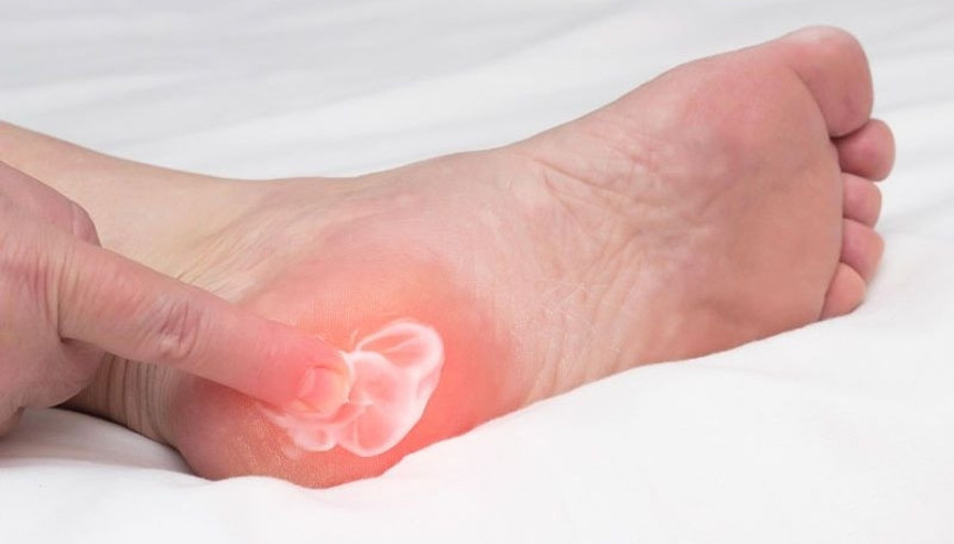 Topuk dikeni neden olur ve nasıl tedavi edilir