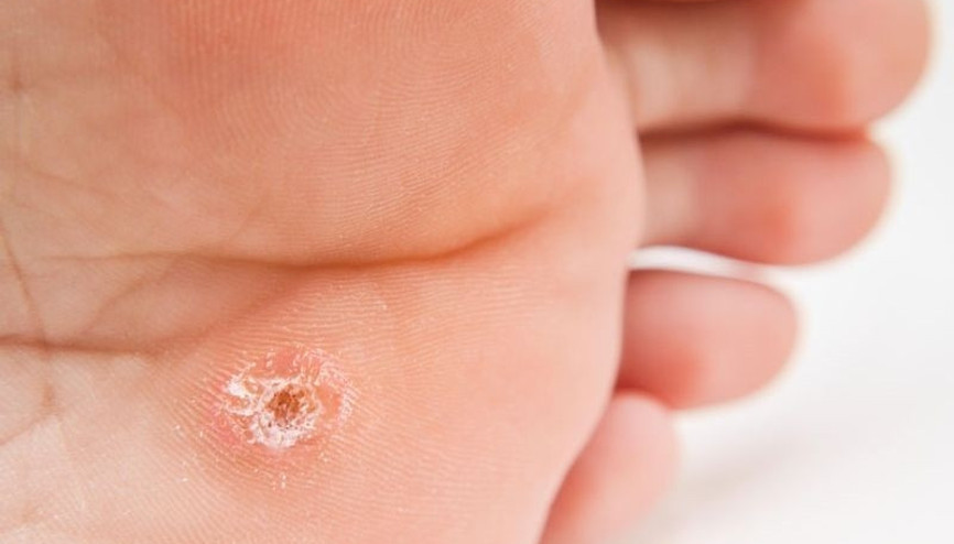 Uzmanından uyarı: Nasırı kesinlikle yakmayın