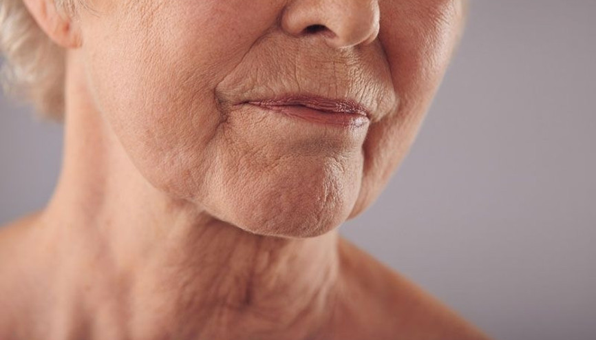 Eksik dişler yüzde kırışıklığa neden oluyor