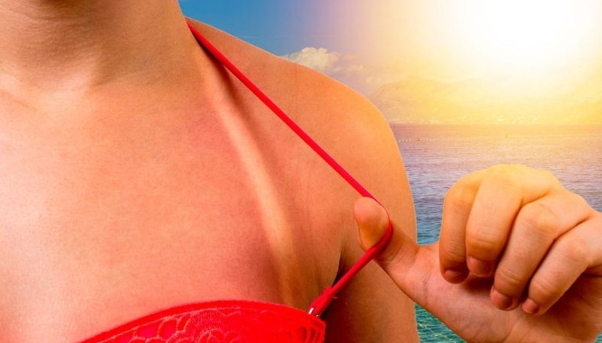 Yoğurt ve diş macunu yanığı tahriş ediyor