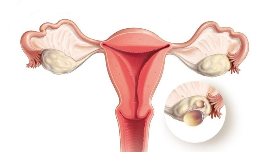 Polikistik over sendromu uzun dönemde sağlık sorunlarına sebep olur mu Polikistik over sendromu uzun dönemde sağlık sorunlarına sebep olur mu