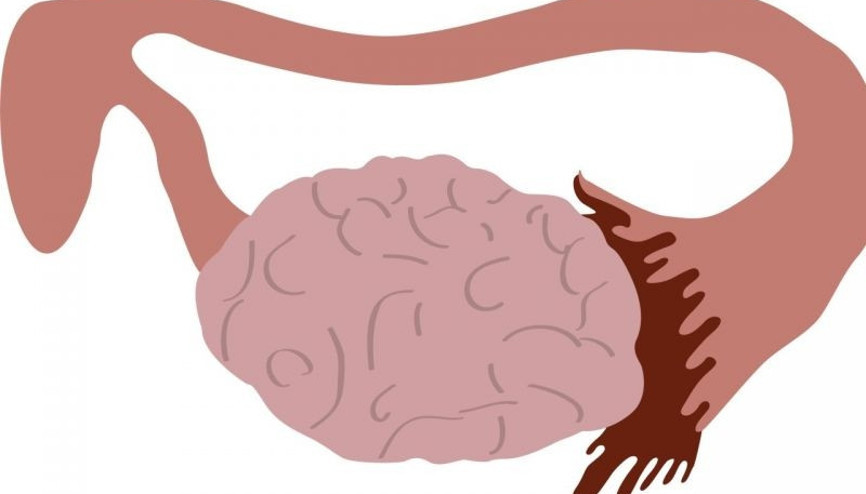 Miyom (myoma uteri) nedir Miyomlar neden gelişir