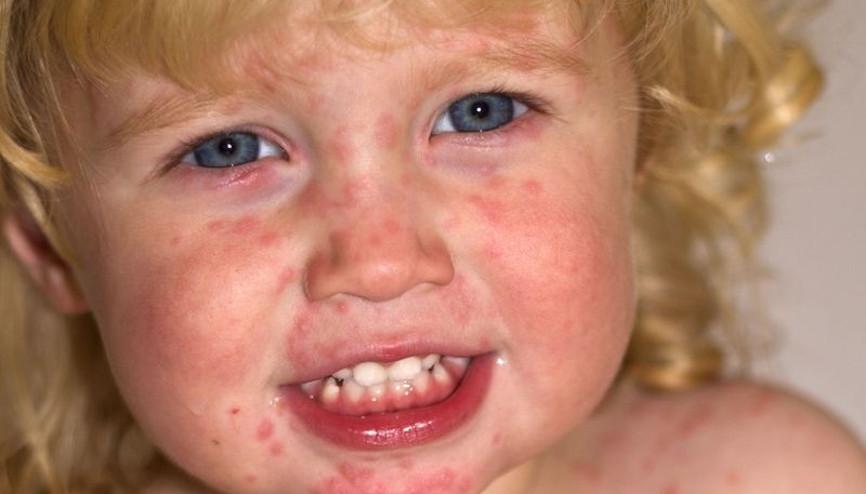 Çocukların hastalanmasının sebebi yediği besinler olabilir