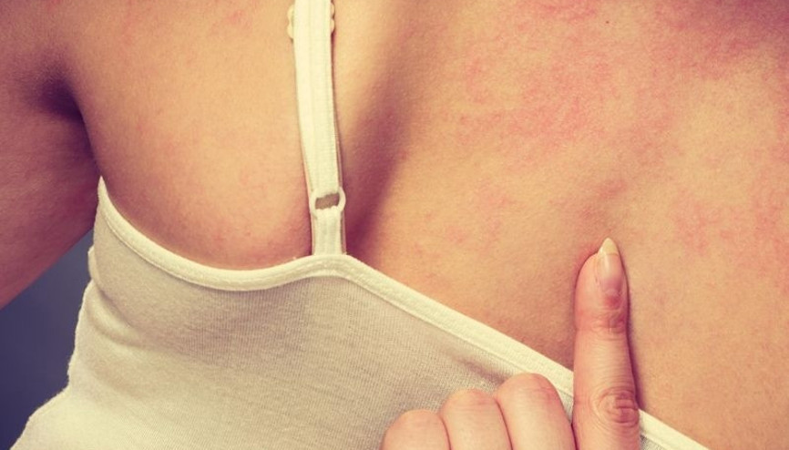 Güneşle ilişkili üç cilt hastalığına dikkat