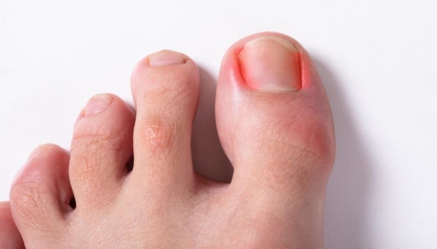 Tırnak batması neden olur Nasıl tedavi edilir