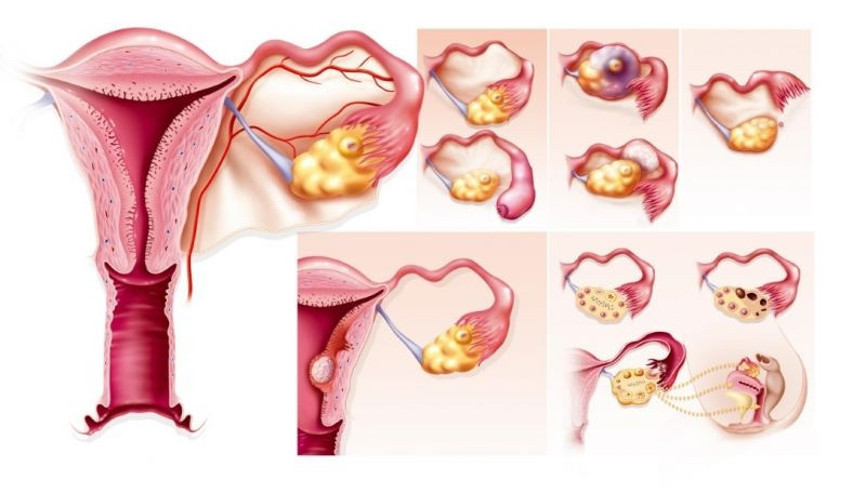 Yaşam tarzınızı değiştirin, polikistik overi yenin