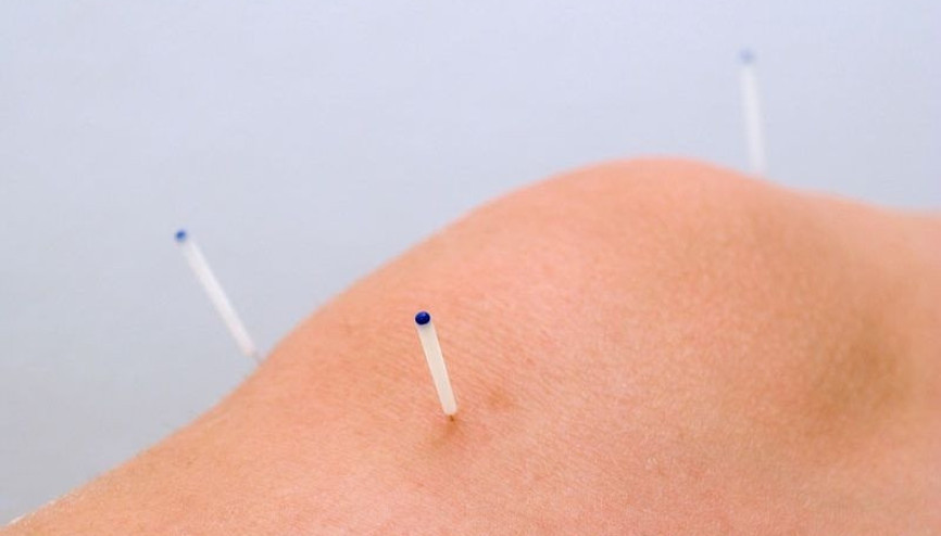 Kuru iğneleme tedavisi nedir, nasıl yapılır