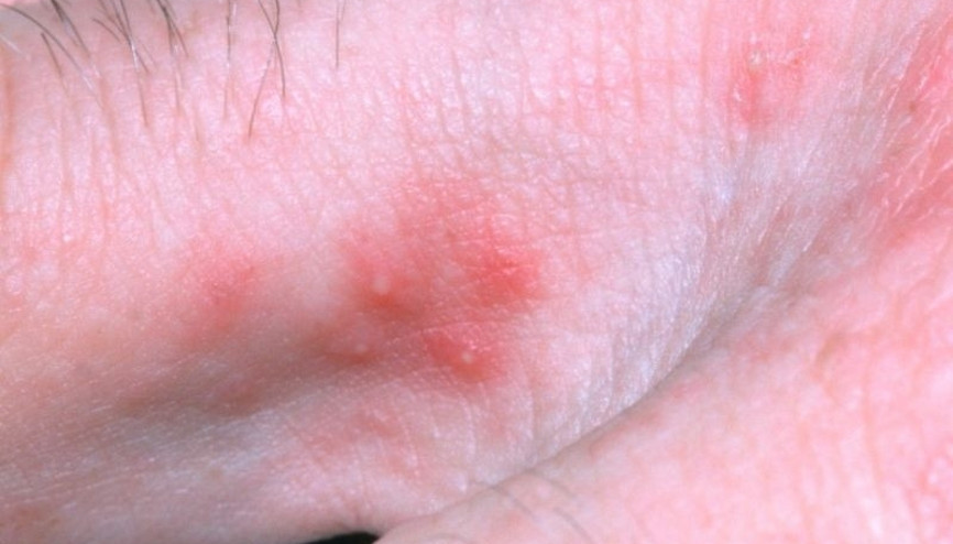 Uyuz nedir Nasıl bulaşır, belirtileri nelerdir