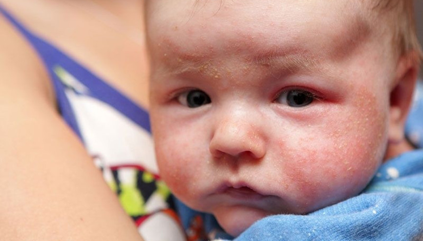 Besin alerjisine en çok çocuklar yakalanıyor