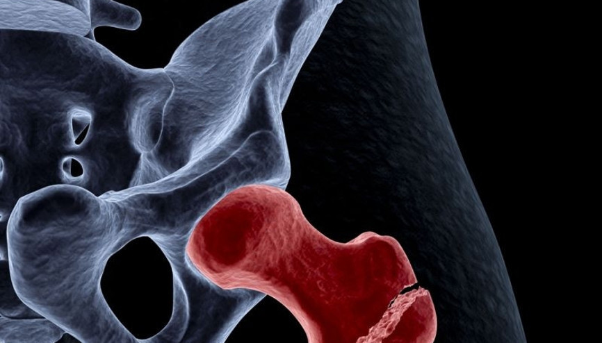 Kalça protezi kimlere yapılır Kalça protezi kimlere yapılır