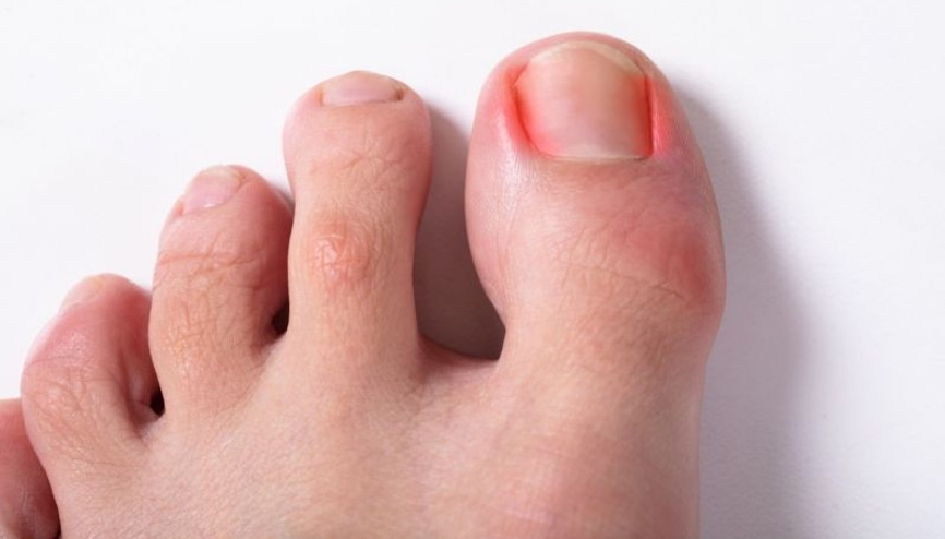 Tırnak batması tedavisi nasıl yapılır