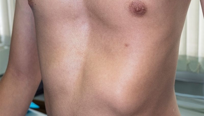 Kunduracı göğsü nedir Dolgu estetiği ile tedavisi mümkün mü