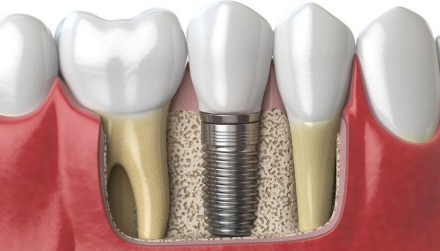 Ağrısız implant mümkün mü