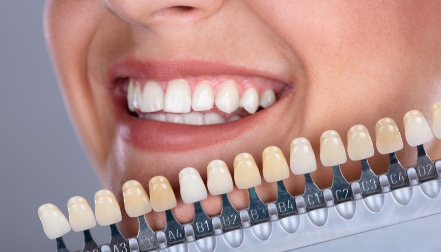 Laminate veneerler nedir