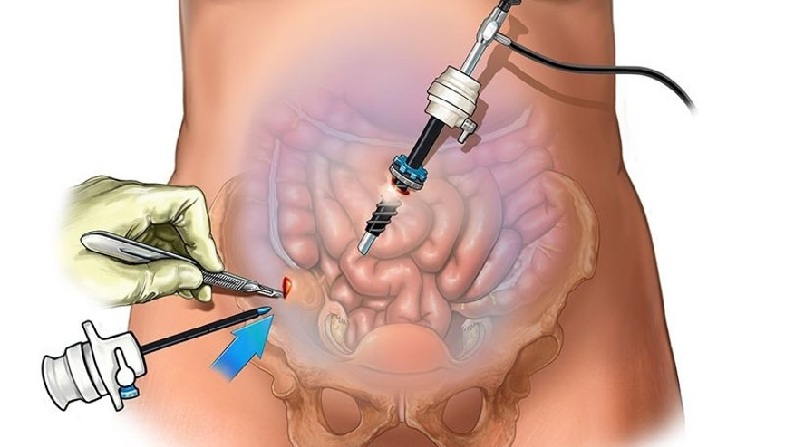Laparoskopik ve histeroskopik cerrahiler gebelik oranını arttırır mı