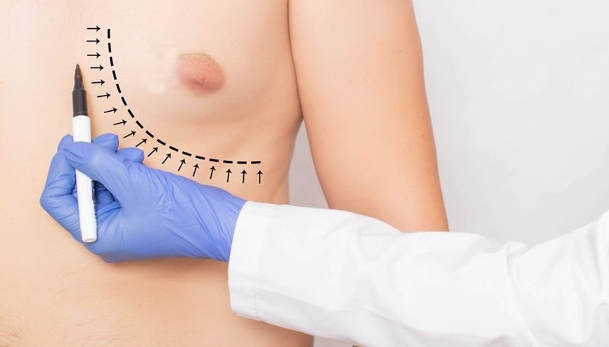 Jinekomasti (erkeklerde meme büyümesi) nedir