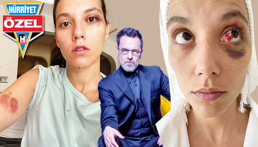 Son dakika haberi... Deniz Bulutsuzun fotoğrafı şok etti: Ozan Güven beni böyle dövdü